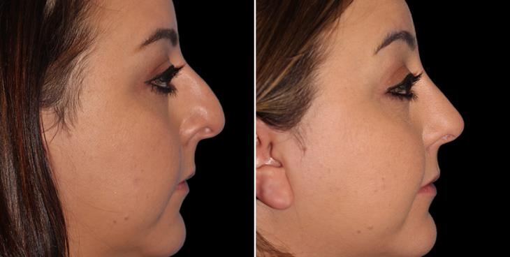 Open Rhinoplasty Results In Atlanta GA Right View